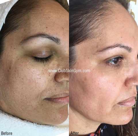 Image of Introductory Offer- Skin Rejuvenation Process