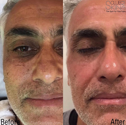 Image of Introductory Offer- Skin Rejuvenation Process