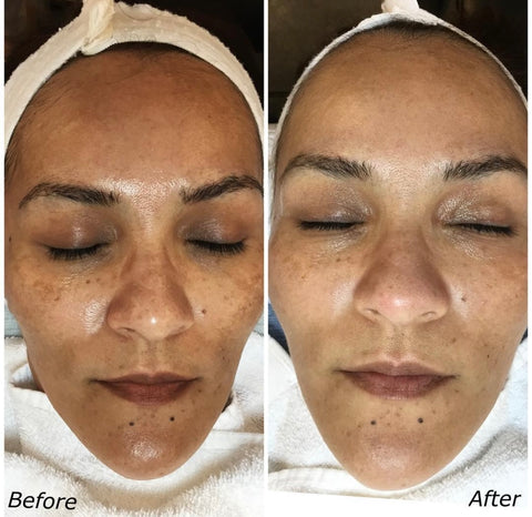 Image of Introductory Offer- Skin Rejuvenation Process