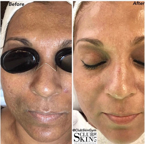 Image of Introductory Offer- Skin Rejuvenation Process