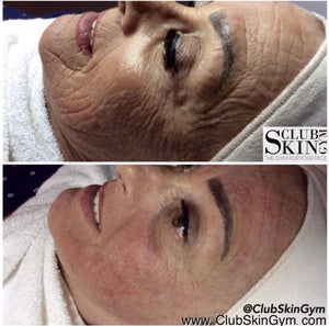 Introductory Offer- Skin Rejuvenation Process
